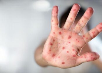 الصحة العالمية : وباء الحصبة يجتاح أوزبكستان 2024