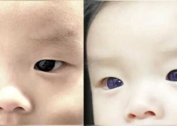 ثورة فى عالم الطب ...دواء  للسعال يغير لون عين  طفل من البنى إلى الأزرق  2025