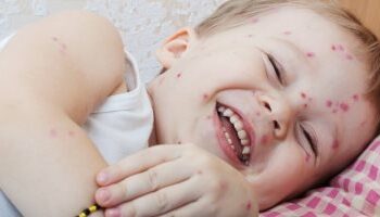 انتشار وباء الجدرى بين اطفال بريطانيا  2025