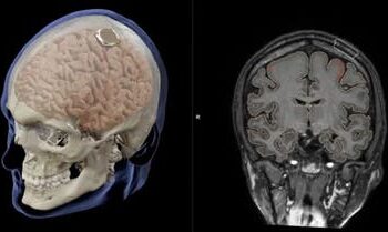 الإعلان عن نجاح زراعة شريحة دماغية في أول إنسان 2024