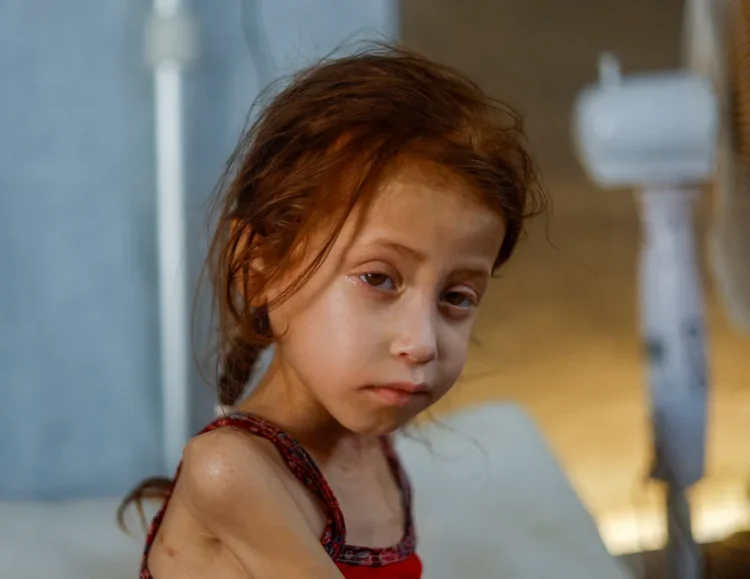 إسرائيل تقتل الطفولة في غزة: 70 ألف طفل يواجهون الجوع وسوء التغذية 2025