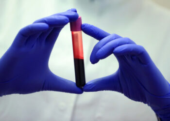 50 شخصًا فقط يحملونه.. سباق عالمي لإنتاج الدم الذهبي في المختبرات 2025